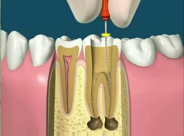 Endodontic Treatment