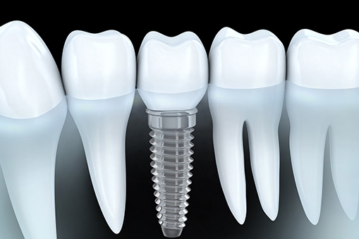 Implant